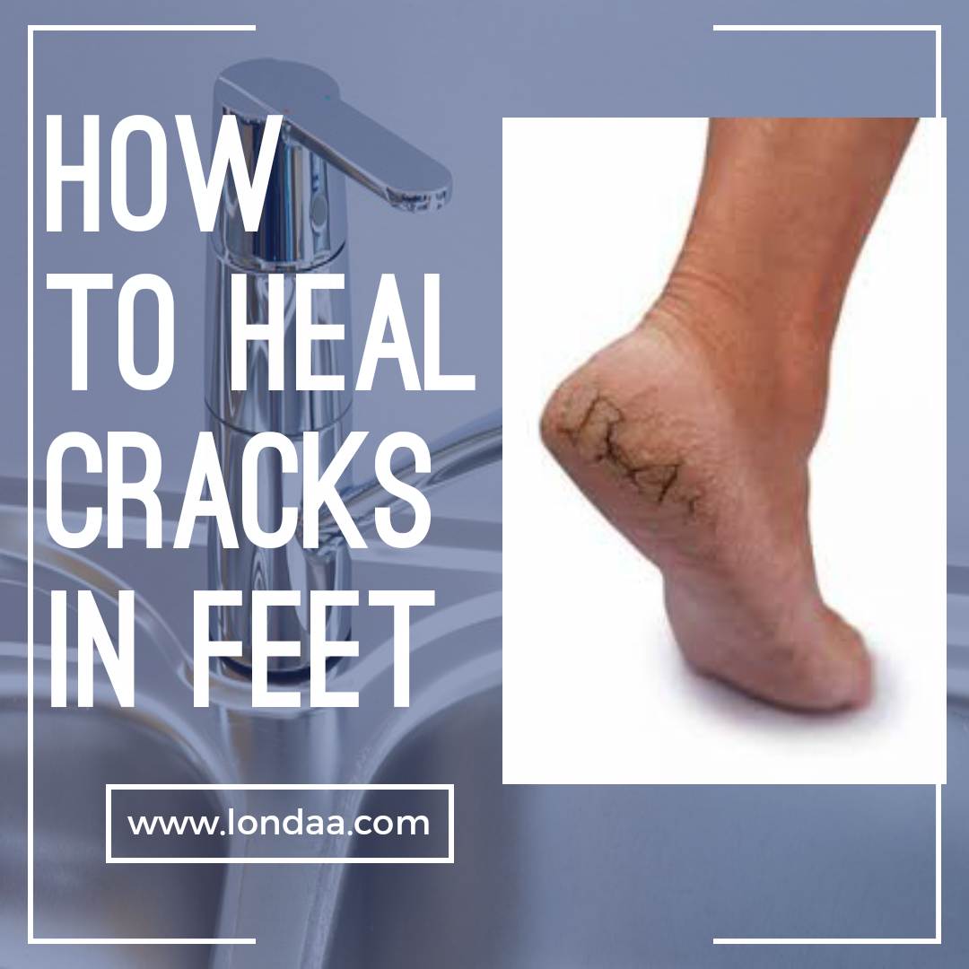 How to heal cracks in feet
