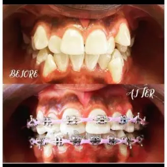 Teeth alignment with braces - 1