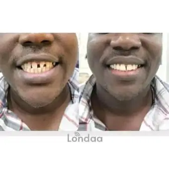 Dental smile transformation