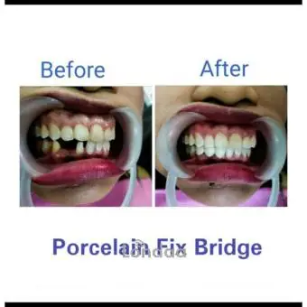Teeth replacement with porcelain