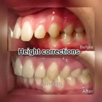 Teeth height correction