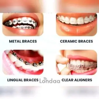 Dental braces