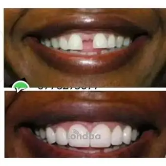 Dental space closure with dental crowns