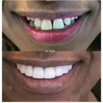 Teeth structure perfection