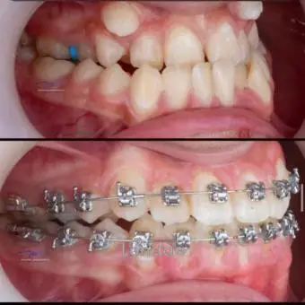 Teeth alignment