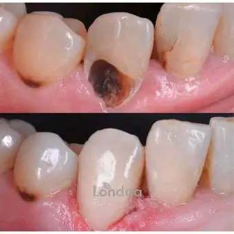 Decayed tooth treatment