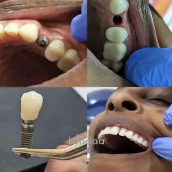 Permanent teeth replacement with an implant