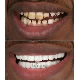 Fluoridated teeth color correction