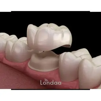 Ceramic dental crowns
