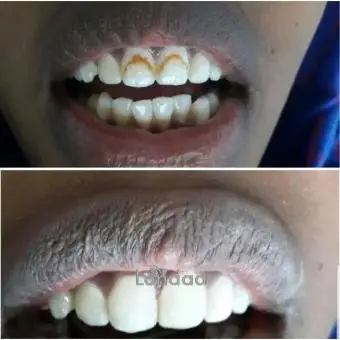 Fluoridated teeth color correction with crowns in Uganda - 1