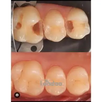 Dental fillings in kampala - 1