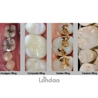 Teeth filling in kampala