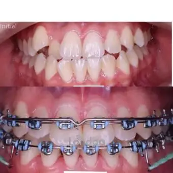 Teeth alignment in kampala - 1