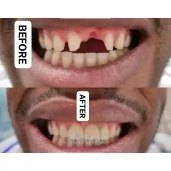 Teeth replacement in kampala
