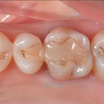 Dental filling kampala