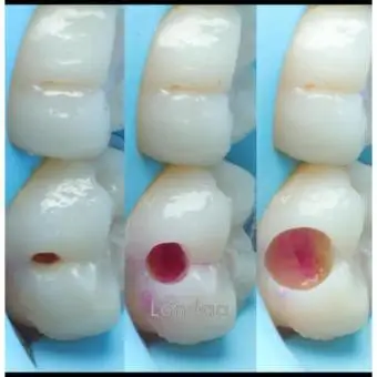 Cavity filling kampala - 1