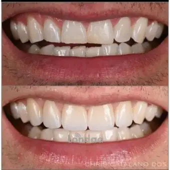 short teeth treatment kampala