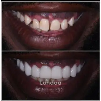 Fluoride teeth treatment kampala Uganda