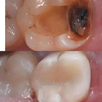 Decayed tooth cavity treatment in Kampala