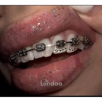 Teeth gem stones on braced teeth in kampala
