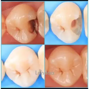 Treating teeth with holes in them at kampala dental solutions