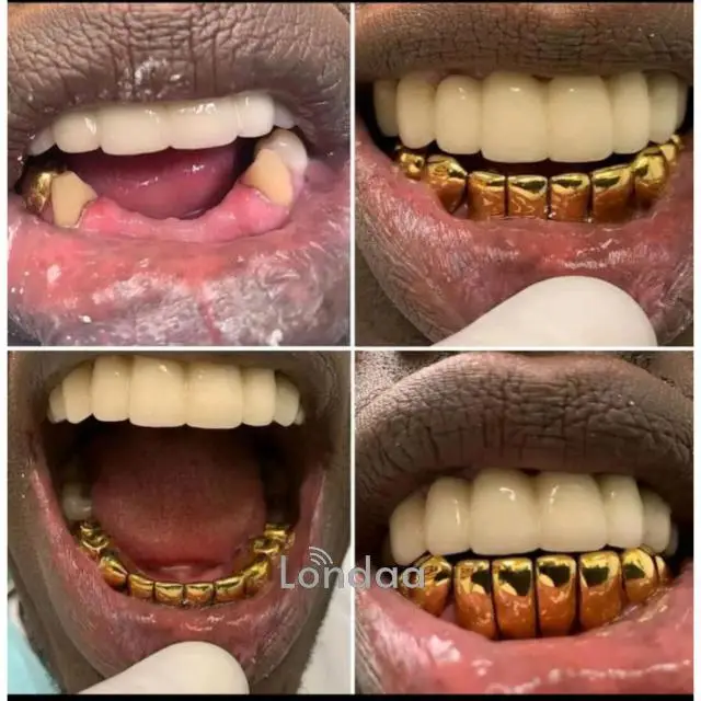 Teeth replacement with gold teeth in kampala - 1/1