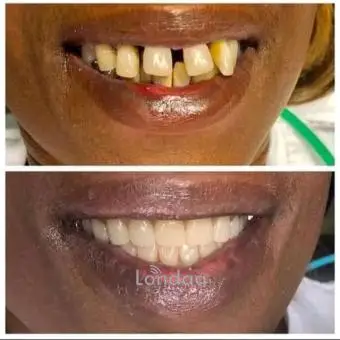 Teeth smile makeover with crowns in kampala