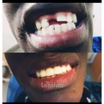 Dental artificial teeth replacement bridge in kampala