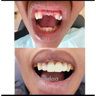 Artificial teeth restoration With a dental bridge in kampala