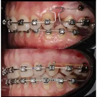 Teeth alignment with braces in kampala Uganda - 2