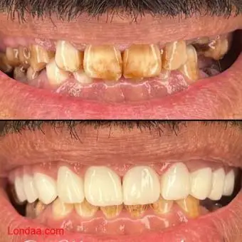 Best teeth crowning clinic in kampala