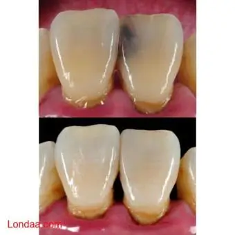 Decayed tooth treatment near me