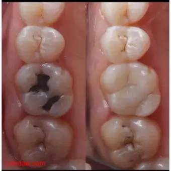 Best teeth filling clinic in kampala