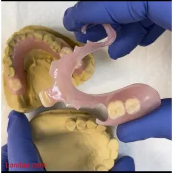 Removable denture for teeth replacement in Kampala