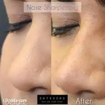 Nose sharppening cream and oils call +256777422022 - 2