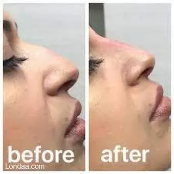 Nose sharppening cream and oils call +256777422022 - 3