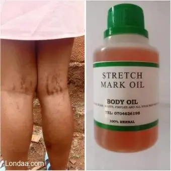 STRETCH MARK REMOVER